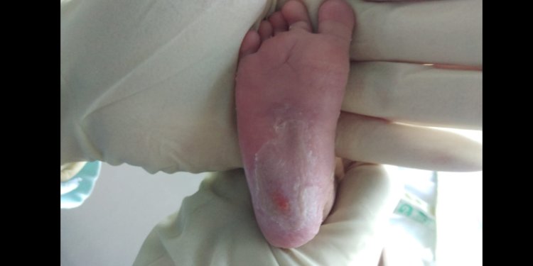 Kondisi terbaru kaki bayi dari Ibnu Sanjaya Hutabarat/Ist